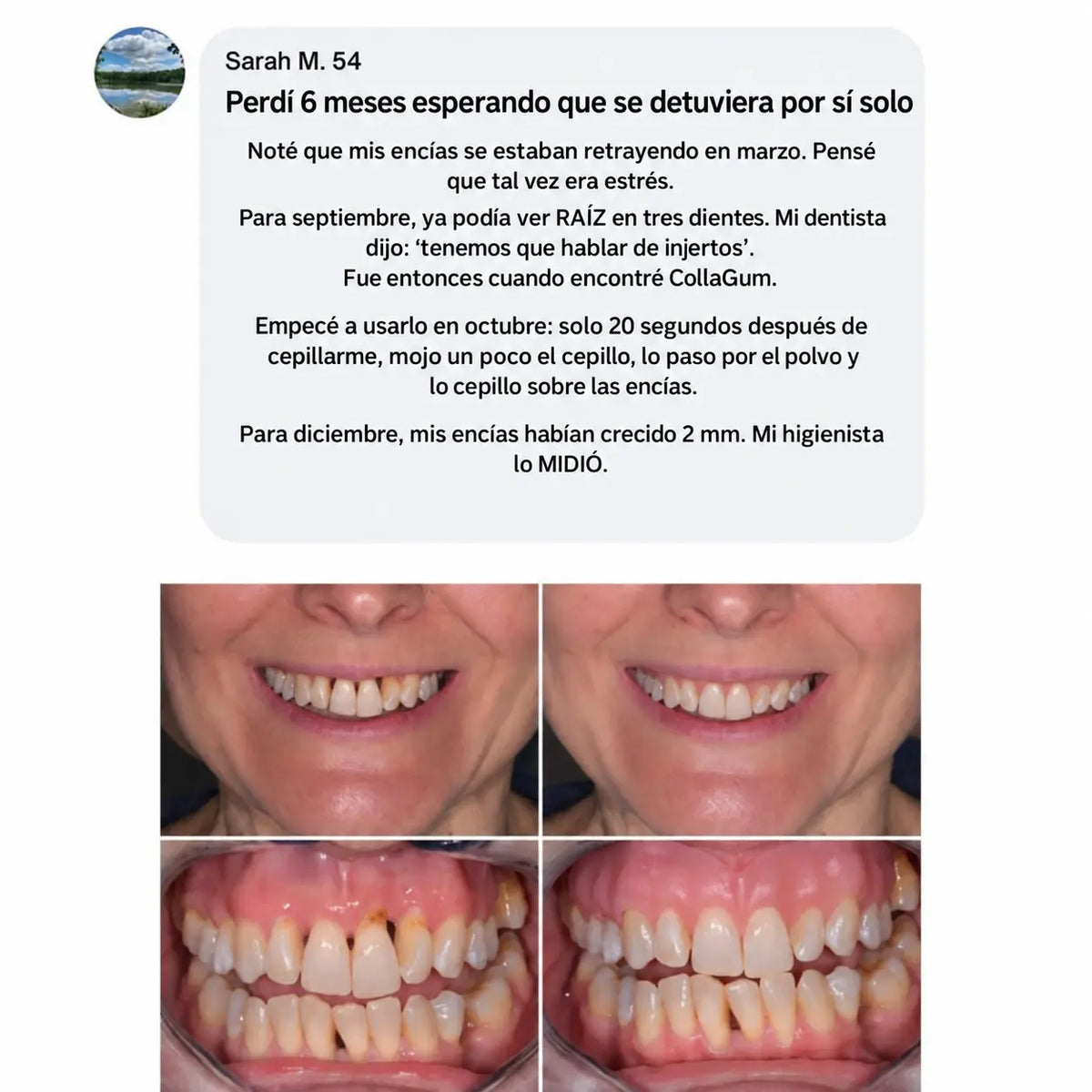 Colla Gum® - Fortalece las encías y el esmalte