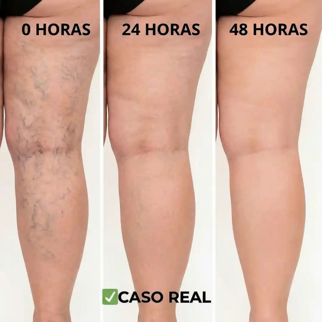 Parches Naturales para venas Varices
