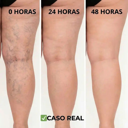 Parches Naturales para venas Varices